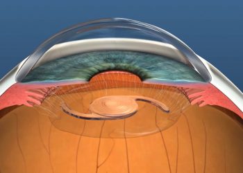 Lens implant and replacement description image