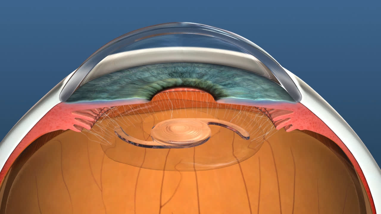 Lens implant and replacement description image